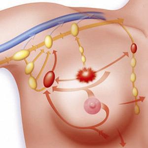 Arquivo de ooforoplastia aberta - Mastologista e Oncoginecologista